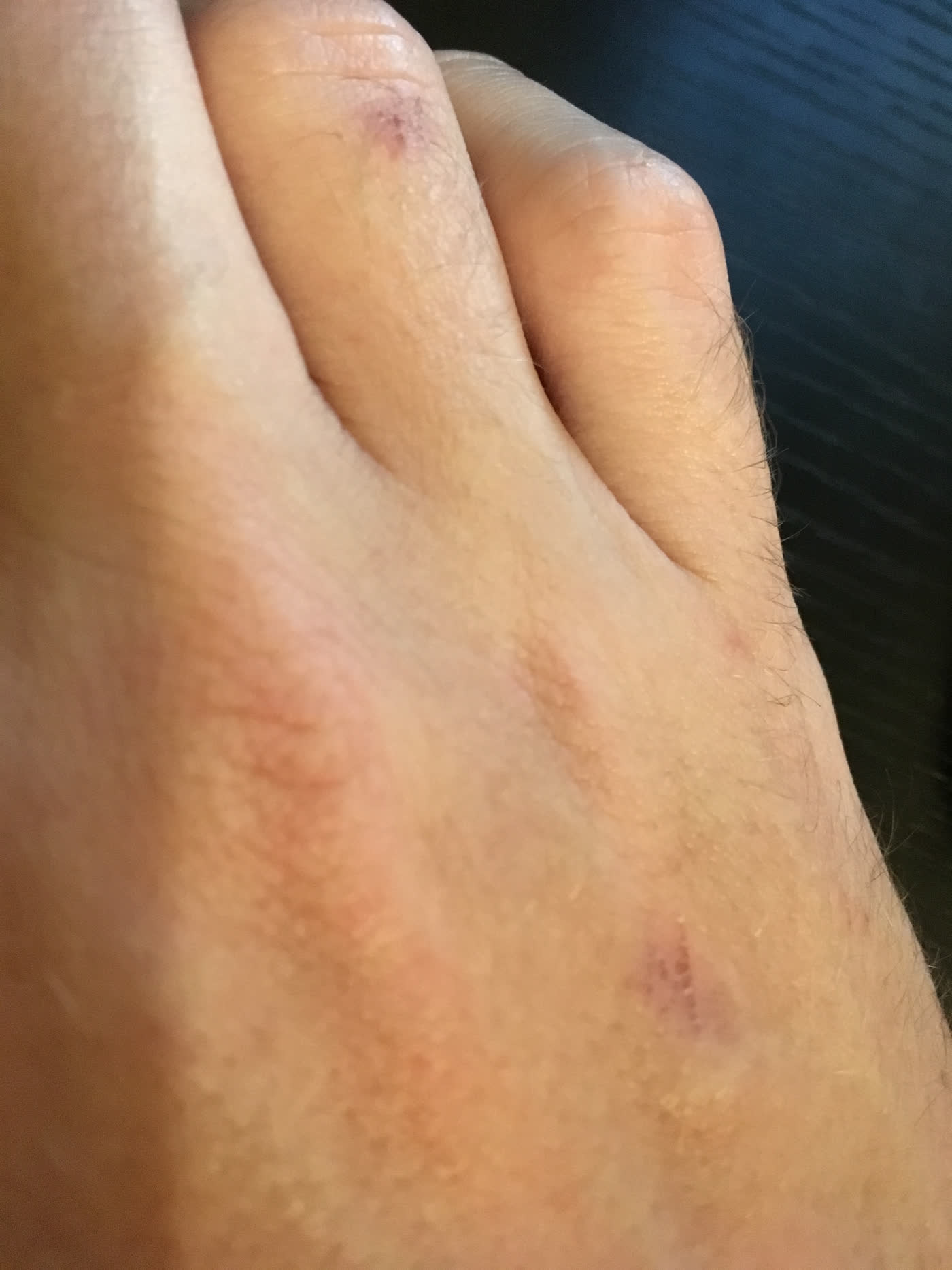 Scratched hand from velcro